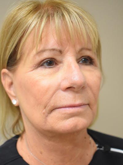Facelift Before & After Gallery - Patient 405209 - Image 4