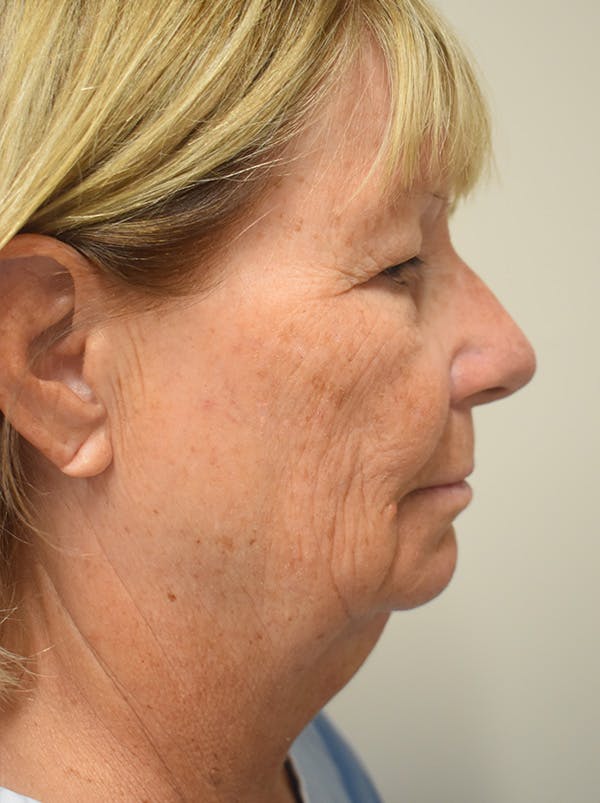 Facelift Before & After Gallery - Patient 405209 - Image 5