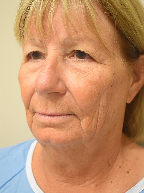 Facelift Before & After Gallery - Patient 405209 - Image 7