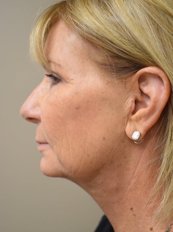 Facelift Before & After Gallery - Patient 405209 - Image 10
