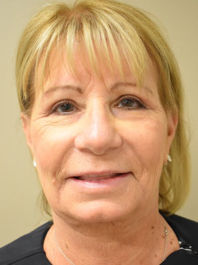 Facelift Before & After Gallery - Patient 405209 - Image 2