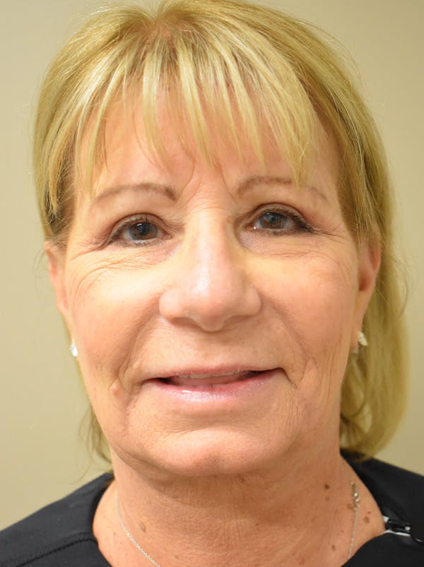 Facelift Before & After Gallery - Patient 405209 - Image 2