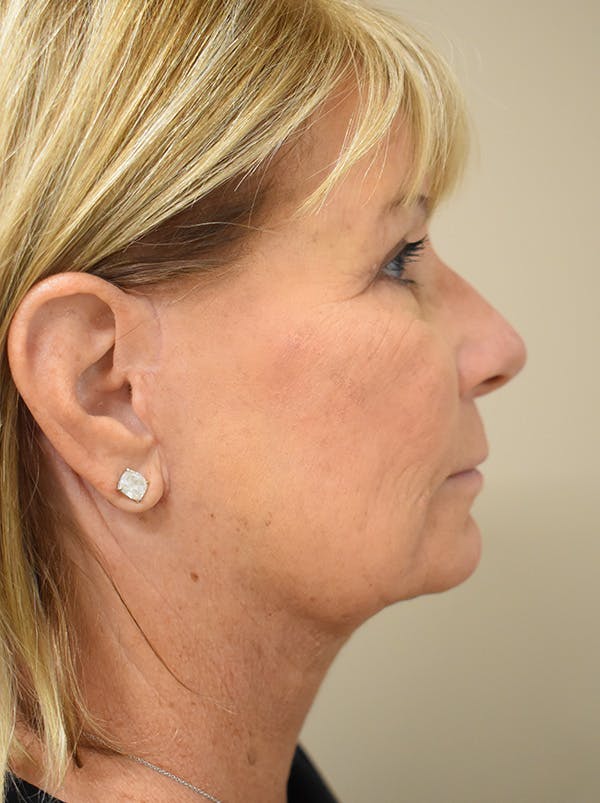 Facelift Before & After Gallery - Patient 405209 - Image 6