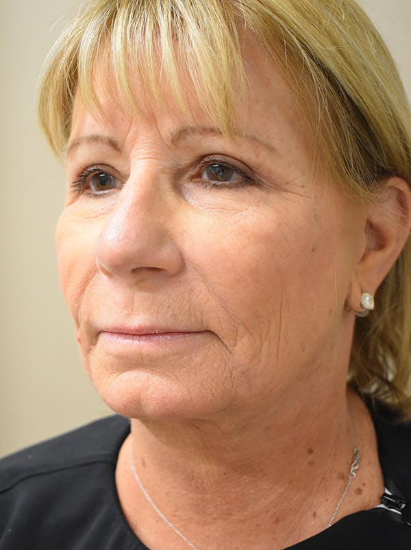 Facelift Before & After Gallery - Patient 405209 - Image 8