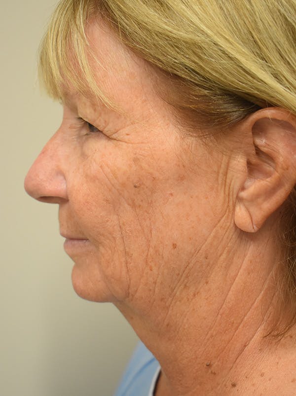 Facelift Before & After Gallery - Patient 405209 - Image 9