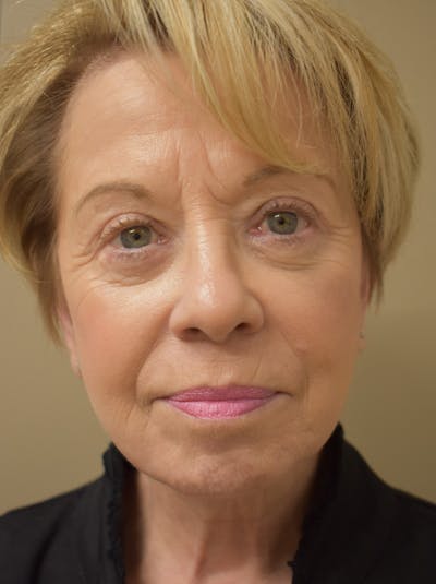 Facelift Before & After Gallery - Patient 377639 - Image 2