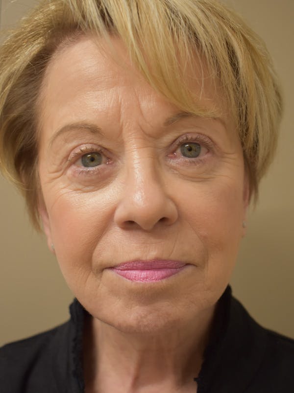 Facelift Before & After Gallery - Patient 377639 - Image 2