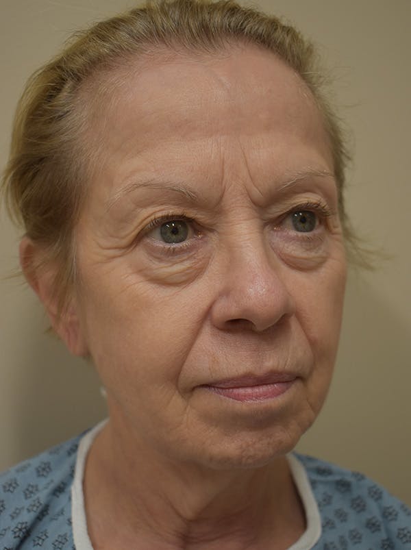 Facelift Before & After Gallery - Patient 377639 - Image 3