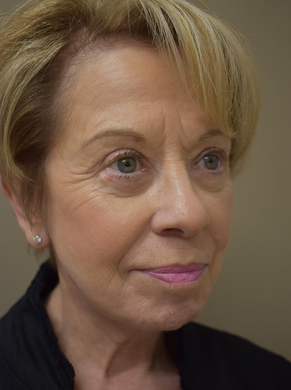 Facelift Before & After Gallery - Patient 377639 - Image 4