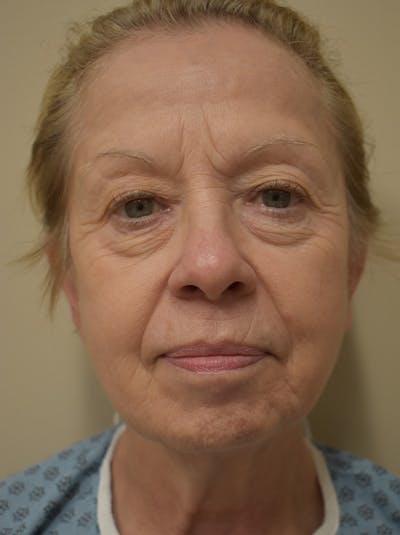 Facelift Before & After Gallery - Patient 377639 - Image 1