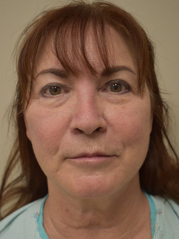 Facelift Before & After Gallery - Patient 396020 - Image 1