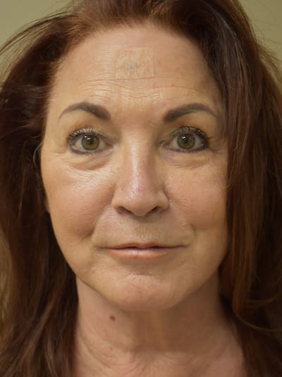 Facelift Before & After Gallery - Patient 396020 - Image 2