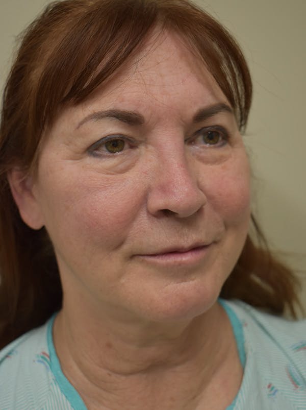 Facelift Before & After Gallery - Patient 396020 - Image 3