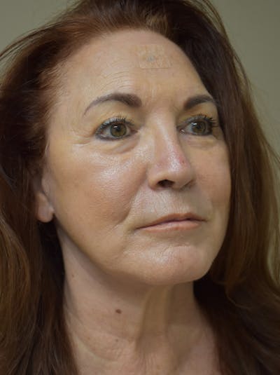 Facelift Before & After Gallery - Patient 396020 - Image 4