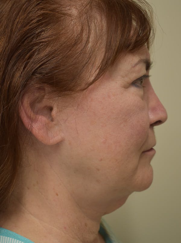 Facelift Before & After Gallery - Patient 396020 - Image 5