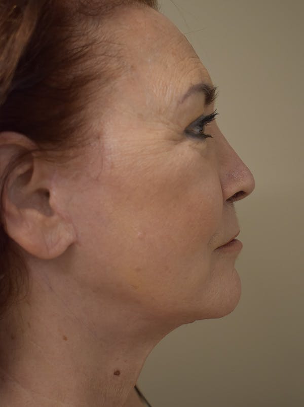 Facelift Before & After Gallery - Patient 396020 - Image 6