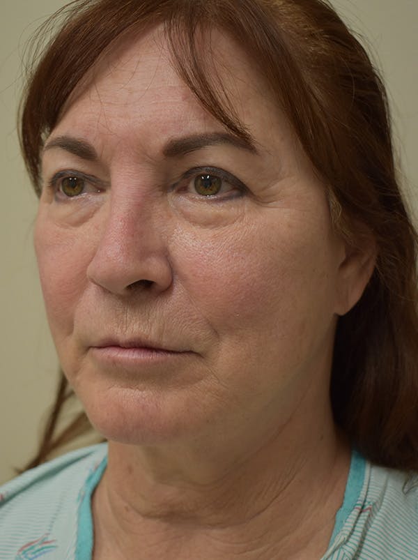 Facelift Before & After Gallery - Patient 396020 - Image 7