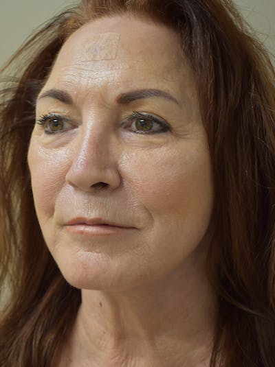 Facelift Before & After Gallery - Patient 396020 - Image 8