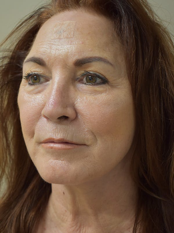 Facelift Before & After Gallery - Patient 396020 - Image 8