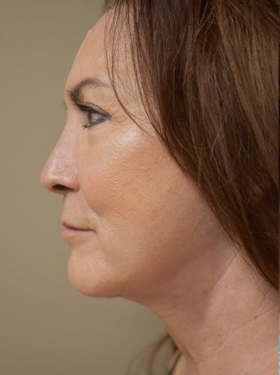 Facelift Before & After Gallery - Patient 396020 - Image 10