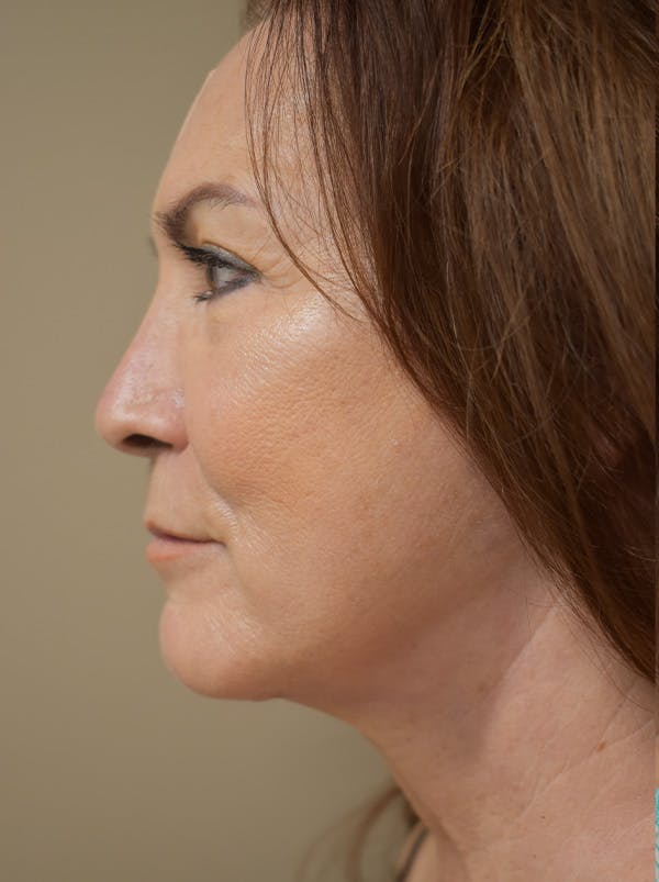 Facelift Before & After Gallery - Patient 396020 - Image 10