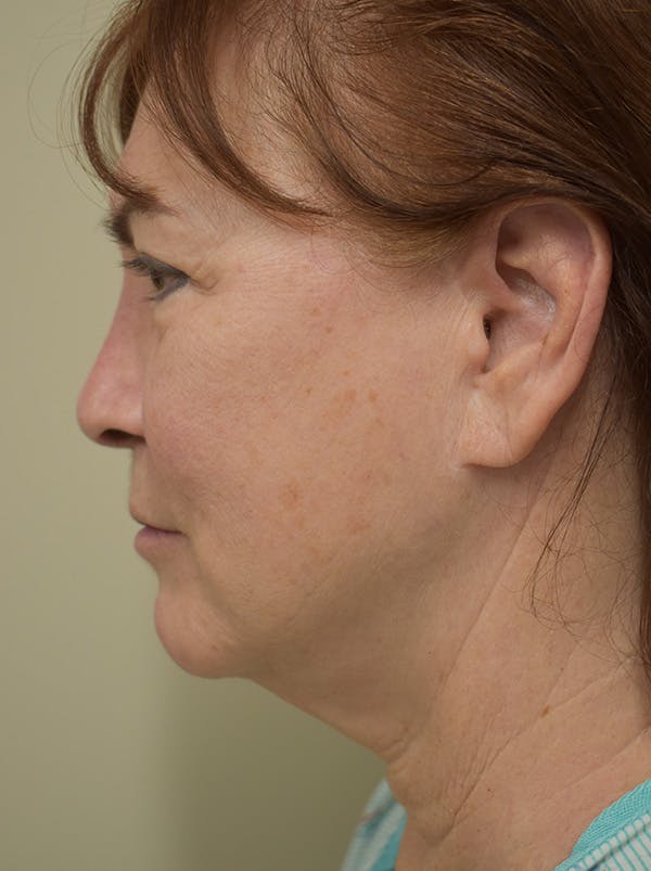 Facelift Before & After Gallery - Patient 396020 - Image 9