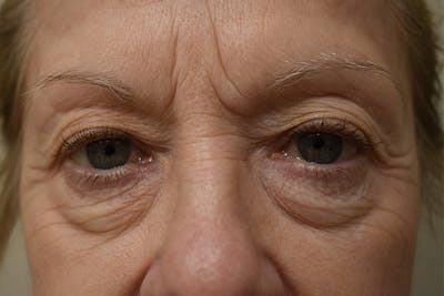 Eyelid Surgery Before & After Gallery - Patient 345817 - Image 1