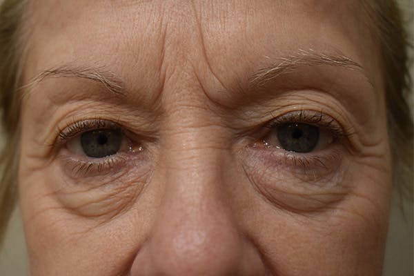 Eyelid Surgery Before & After Gallery - Patient 345817 - Image 1