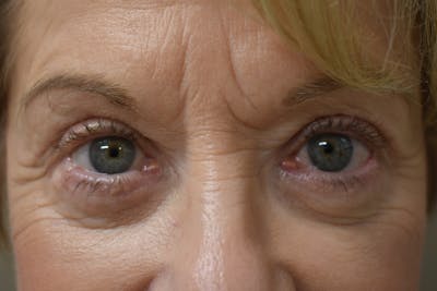 Eyelid Surgery Before & After Gallery - Patient 345817 - Image 2