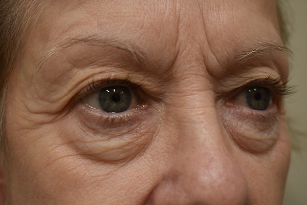 Eyelid Surgery Before & After Gallery - Patient 345817 - Image 3