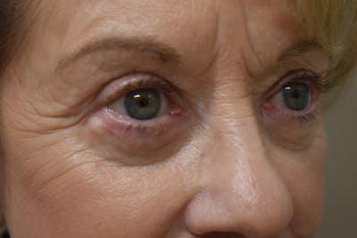 Eyelid Surgery Before & After Gallery - Patient 345817 - Image 4