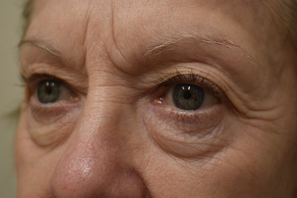 Eyelid Surgery Before & After Gallery - Patient 345817 - Image 5