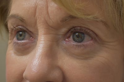 Eyelid Surgery Before & After Gallery - Patient 345817 - Image 6