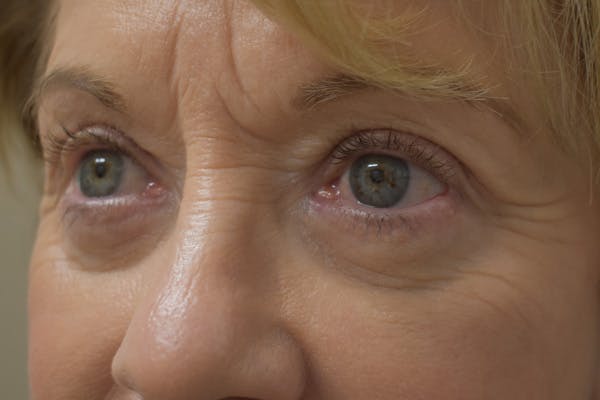 Eyelid Surgery Before & After Gallery - Patient 345817 - Image 6