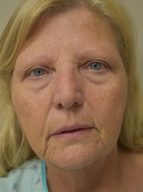 Facelift Before & After Gallery - Patient 289996 - Image 1