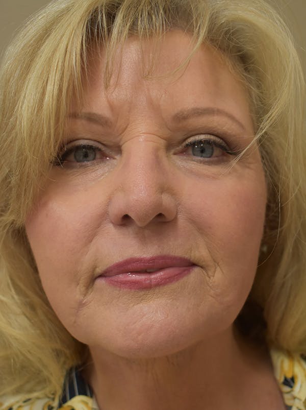 Facelift Before & After Gallery - Patient 289996 - Image 2