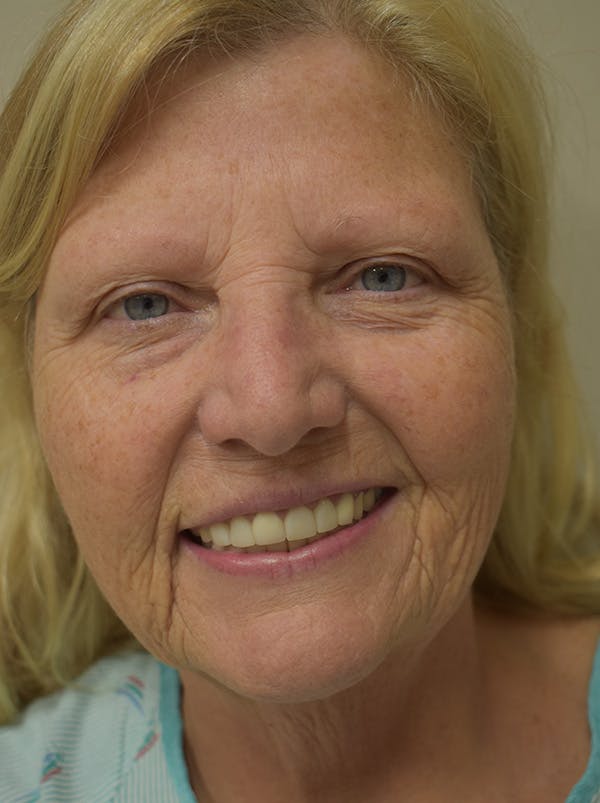 Facelift Before & After Gallery - Patient 289996 - Image 3