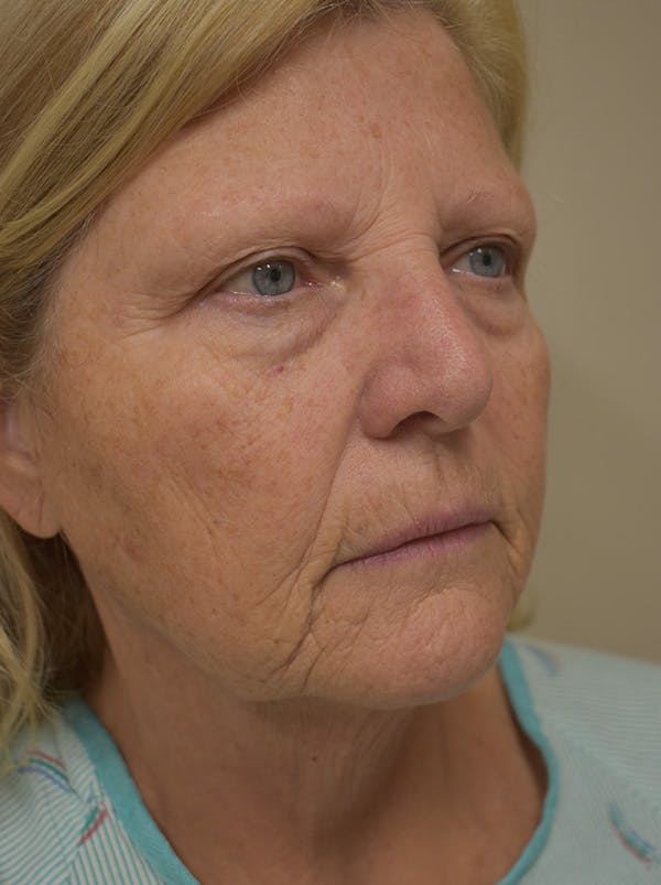 Facelift Before & After Gallery - Patient 289996 - Image 5