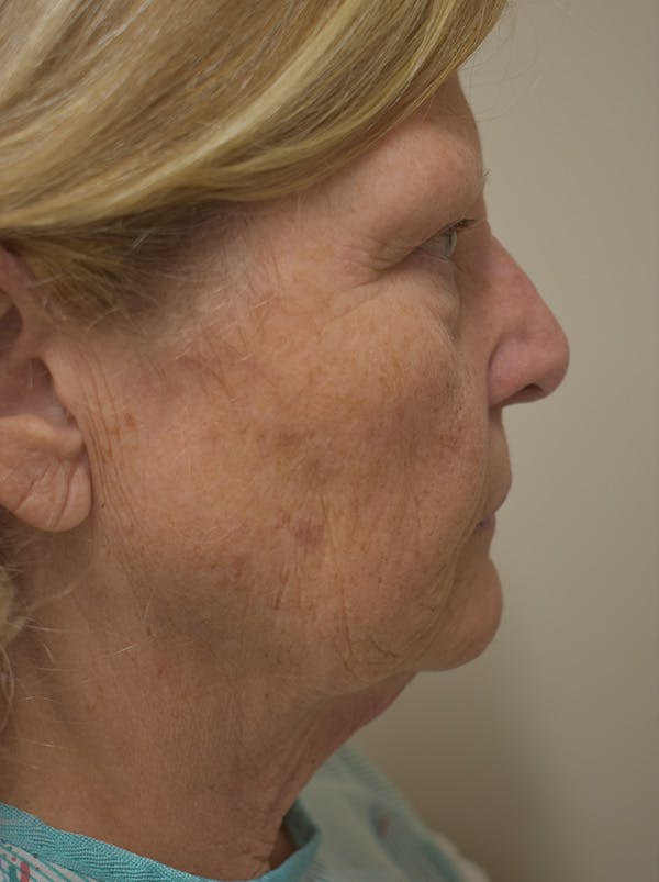 Facelift Before & After Gallery - Patient 289996 - Image 7