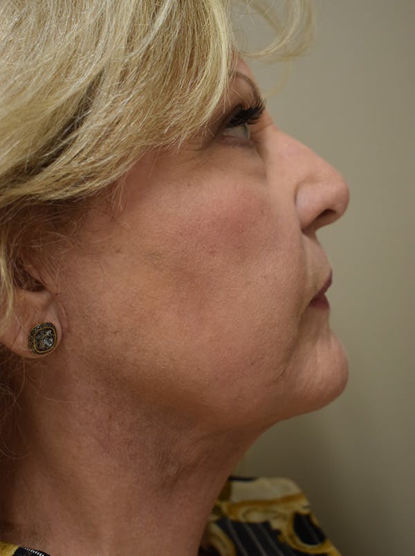 Facelift Before & After Gallery - Patient 289996 - Image 8
