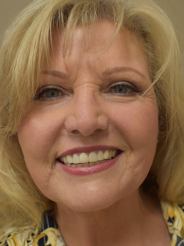 Facelift Before & After Gallery - Patient 289996 - Image 4