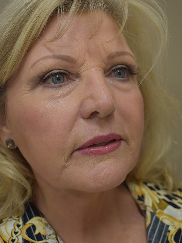 Facelift Before & After Gallery - Patient 289996 - Image 6