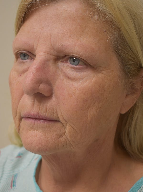 Facelift Before & After Gallery - Patient 289996 - Image 9