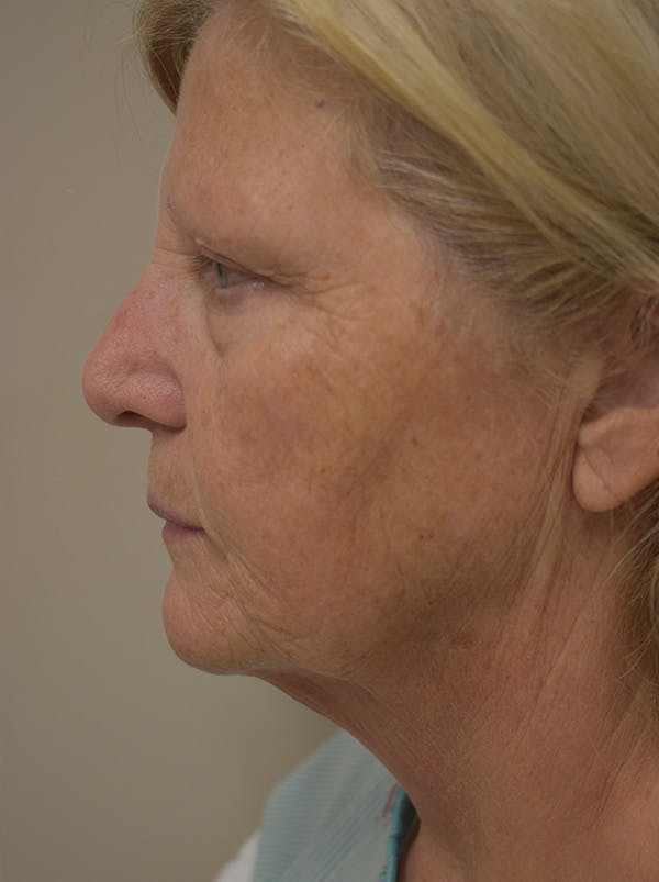 Facelift Before & After Gallery - Patient 289996 - Image 11