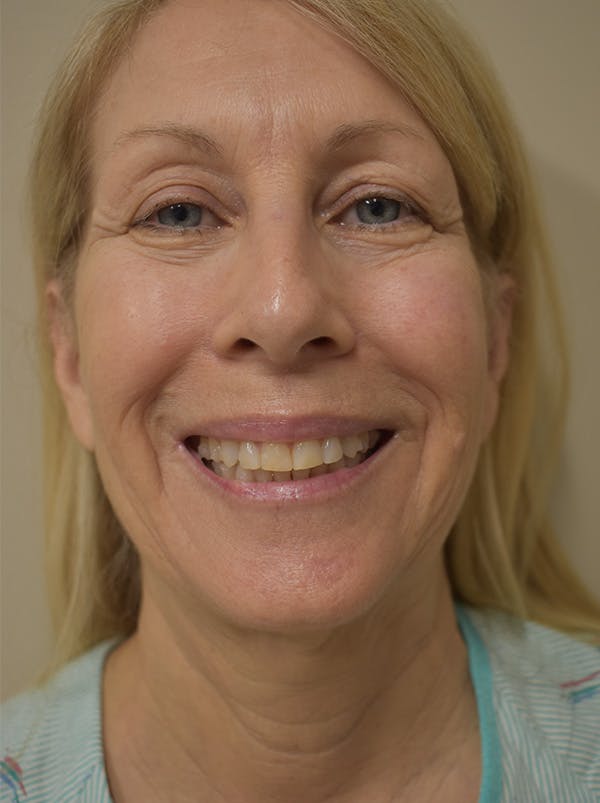 Facelift Before & After Gallery - Patient 512585 - Image 1
