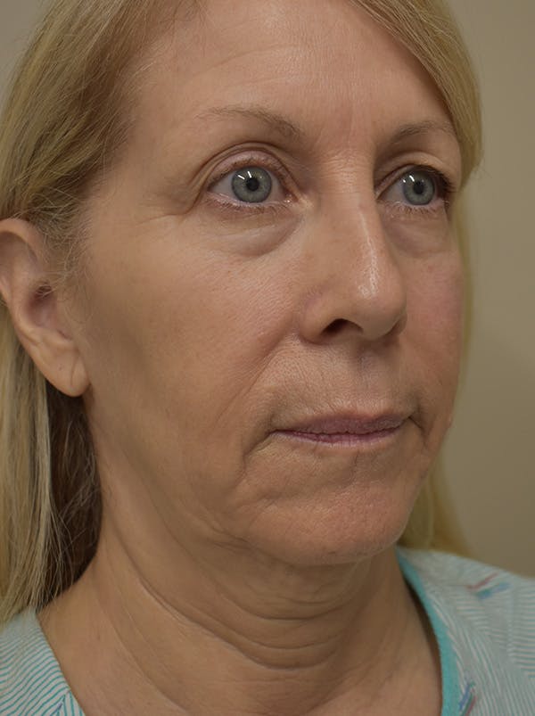 Facelift Before & After Gallery - Patient 512585 - Image 3