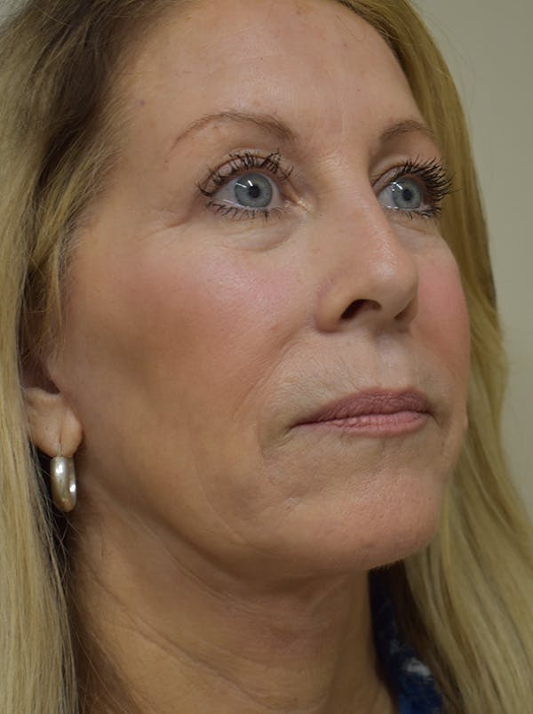 Facelift Before & After Gallery - Patient 512585 - Image 4