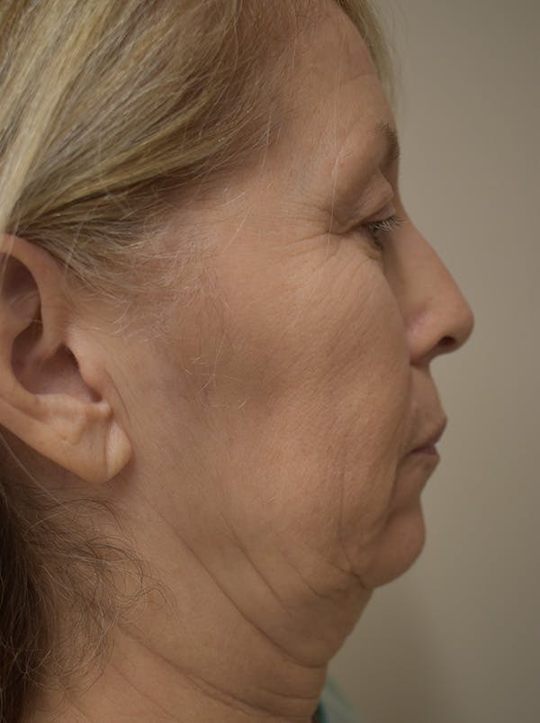 Facelift Before & After Gallery - Patient 512585 - Image 5