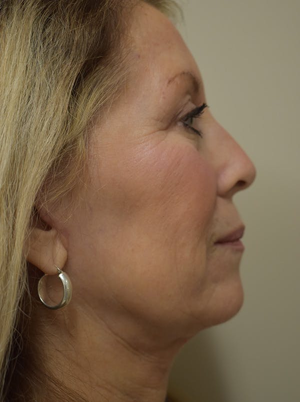 Facelift Before & After Gallery - Patient 512585 - Image 6