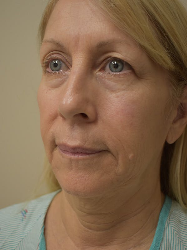 Facelift Before & After Gallery - Patient 512585 - Image 7